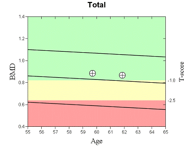 Female Bone Density Chart