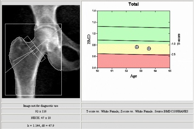 Female Bone Density Chart